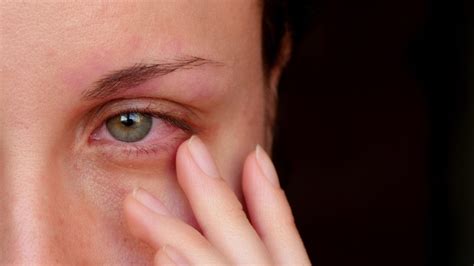 Alcoholic Eyes Symptoms and Treatment - Bodhi Addiction