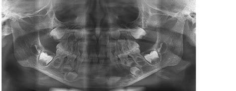 Odontogenic Myxoma in a Pediatric Patient: A Case Report