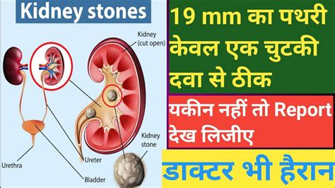 kidney Stones treatment सबसे बड़े पथरी का इलाज केवल 18 दिन में - YouTube