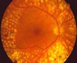 Retinal Hole Laser Treatment | Synergy Eye Care