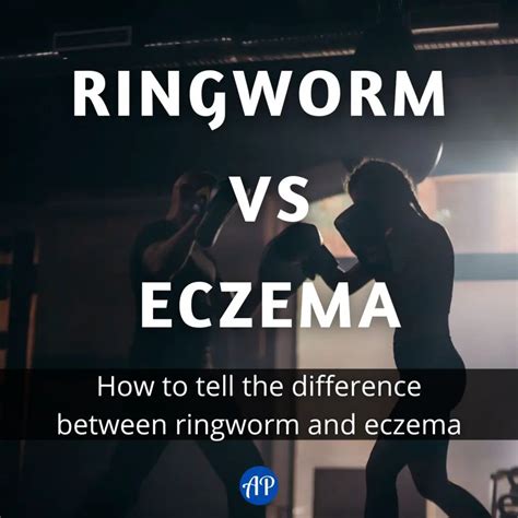 Ringworm vs Eczema: Facts You Need To Know