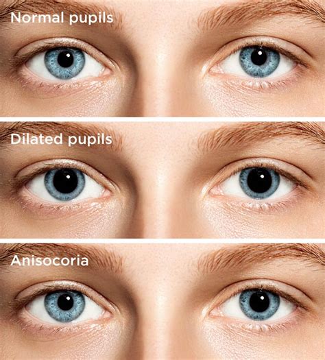 Dilated Pupils: Causes and Concerns