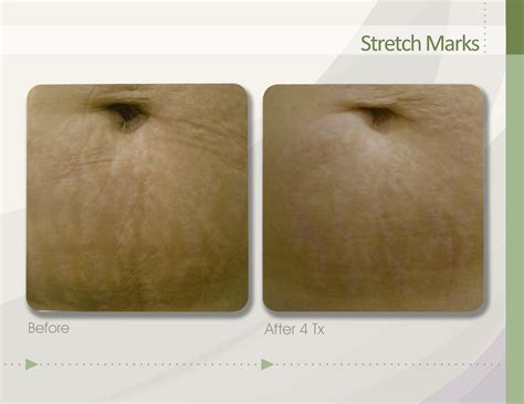 SkinStation: Stretch Marks: Prevention and Cure