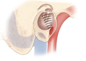 Pulsatile Tinnitus – Oto Surgery Atlas