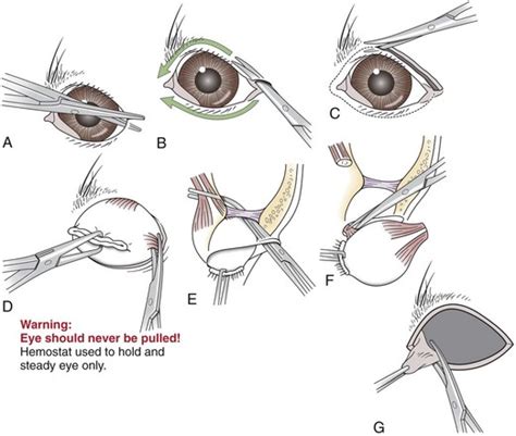 Surgery of the Eye | Veterian Key