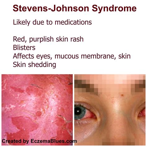 Life Threatening Skin Rash series – Stevens Johnson Syndrome - Eczema Blues