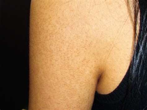 Keratosis Pilaris: Types, Symptoms, Causes, Treatment