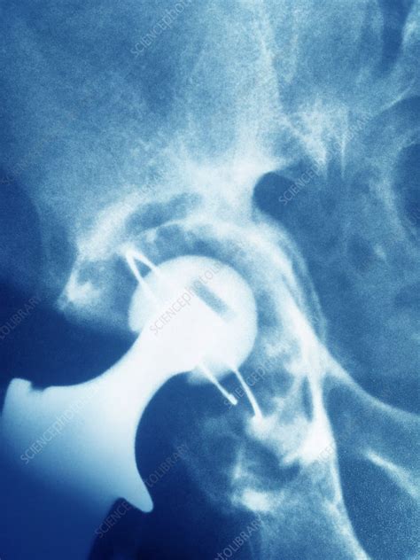 Damaged hip replacement, X-ray - Stock Image - C040/2183 - Science ...