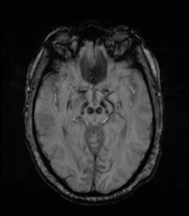 Mri Findings In Parkinson S Disease Radiographics