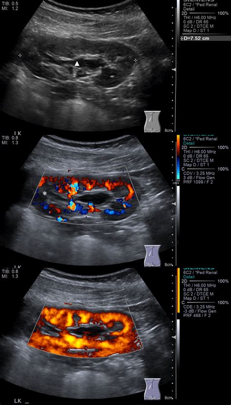 Left Kidney Ultrasound Longitudinal Images | NucsRadiology.com