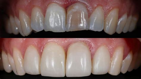 Composite Veneers - Dr Sheryl Smithies - Enamel Dentistry