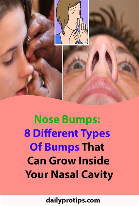 Nose Bumps: 8 Different Types Of Bumps That Can Grow Inside Your Nasal Cavity | Nasal cavity ...