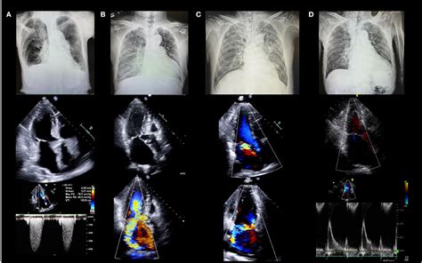 Echocardiogram Of Heart Failure