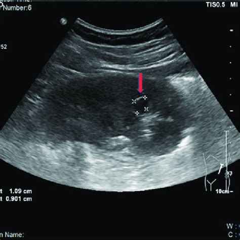 Kidney Anatomy Ultrasound