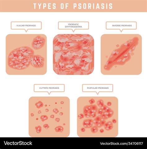 Psoriasis types skin problems close up medical Vector Image