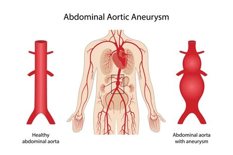 Abdominal Aortic Aneurysm in El Paso, TX