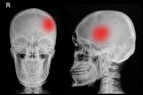 Skull Fracture Types, Symptoms, and Treatment - DDRB Lawyers