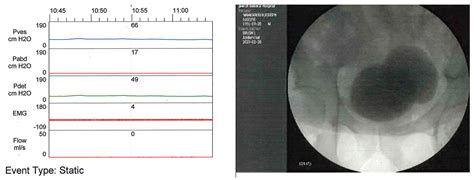 Biomedicines | Free Full-Text | The Utility of Urodynamic Studies in ...