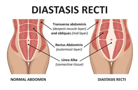 FYZICAL Rockville: Diastasis Rectus: Symptoms, Treatments And Prevention