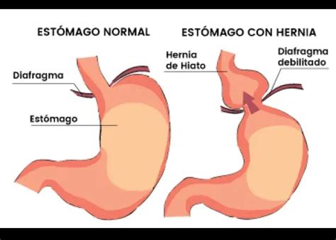 CIRUGIA DE HERNIA DE HIATO - Clínica Centromed