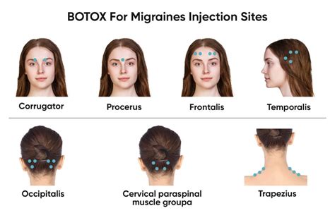 BOTOX MIGRAINE TORONTO | ID Cosmetic Clinic