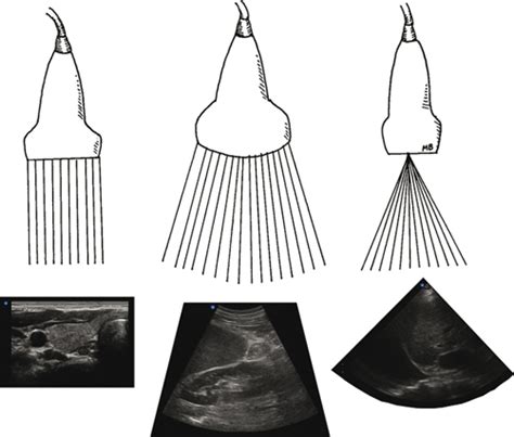 Basics of Ultrasound | Radiology Key