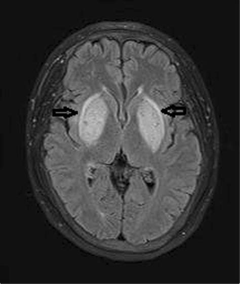 Syndrome of uremic encephalopathy and bilateral basal ganglia lesions in non-diabetic ...