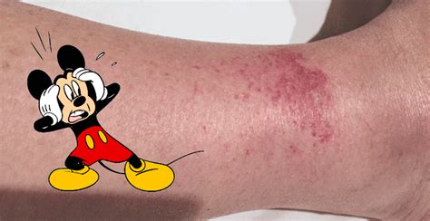 The Disney Rash: What It Is and How to Treat It - Inside the Magic