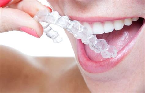 Invisalign Cleaner Solutions – Finding the Best Methods - Surf Oceanside