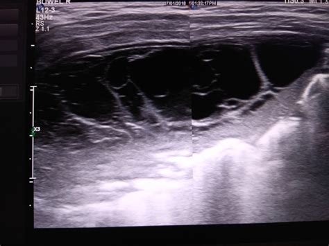 SONO DIGEST: ULTRASOUND CHEST- Empyema thoracis & Enlarged Thymus