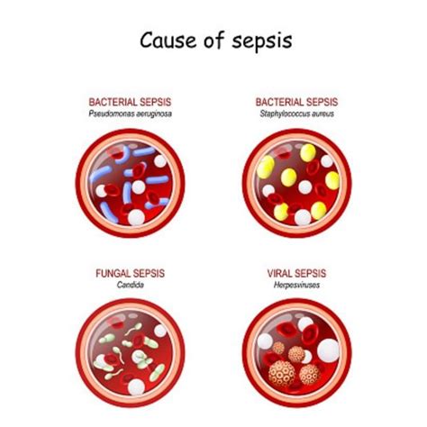 Sepsis symptoms: What causes sepsis? How to prevent the deadly ...