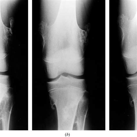 ± (a) Case 2. Radiograph showing bony prominence on the dorsal aspect ...