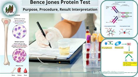 Bence Jones Protein Test Test Purpose, Procedure, Result Interpretation ...