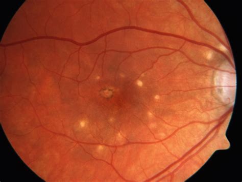 Punctate Inner Choroidopathy with CNV Treated with Bevacizumab # 6 of 7 - Retina Image Bank