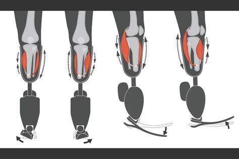 Surgical technique improves sensation, control of prosthetic limb | MIT ...