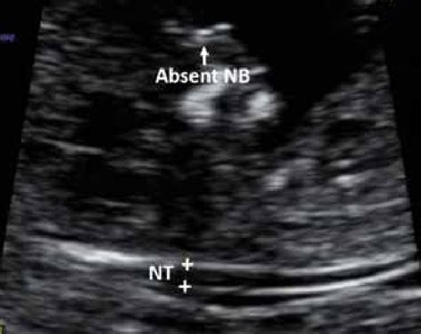 Abnormal/absent nasal bone (NB) and normal nuchal translucency (NT ...