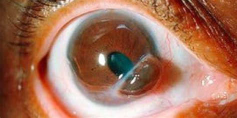 'Corneal Melt': Arthritis Complication Lets Irises Slip Out