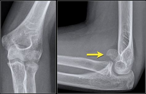 Elbow X Ray Fracture