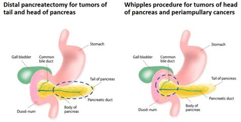 Distal pancreatectomyvsWhipples procedure