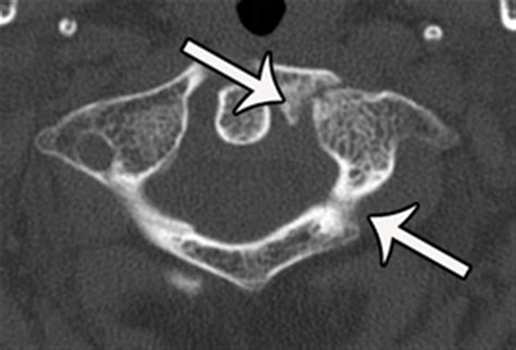 Atlas Fractures & Transverse Ligament Injuries - Spine - Orthobullets