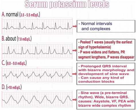 Ecg hyperkalemia | Hyperkalemia, High potassium symptoms, Fluid and electrolytes