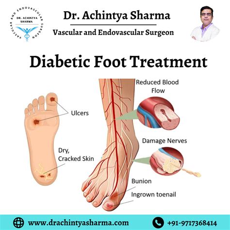 Diabetic Foot treatment | Dr. Achintya Sharma