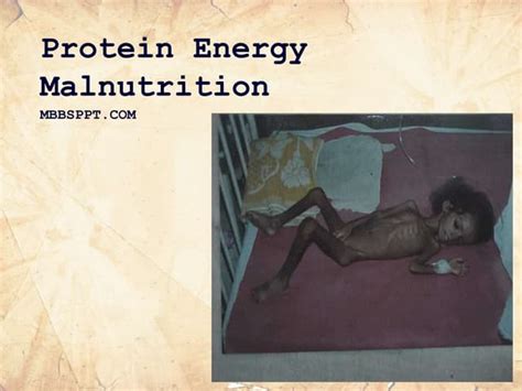 protein-energy-malnutrition.pptx