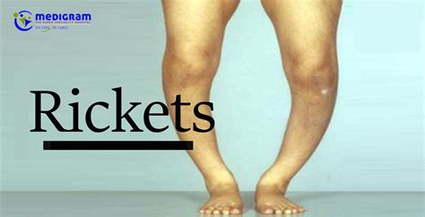 Rickets is a medical condition that affects the bones, causing them to become weak and soft.