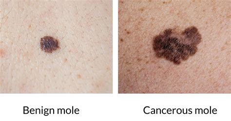 Pictures of cancerous moles: early stage, cancerous moles images, pictures of skin moles ...