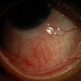 Funds photograph demonstrating severe retinal vasculitis. Significant ...