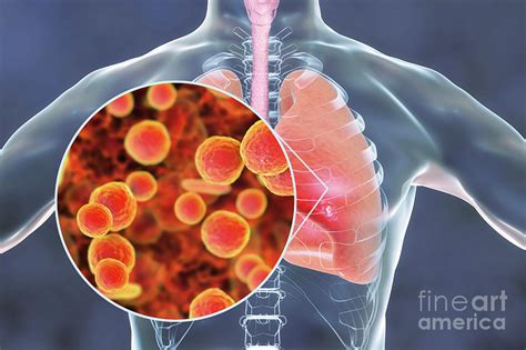 Pneumonia Caused By Mycoplasma Pneumoniae Bacteria Photograph by ...