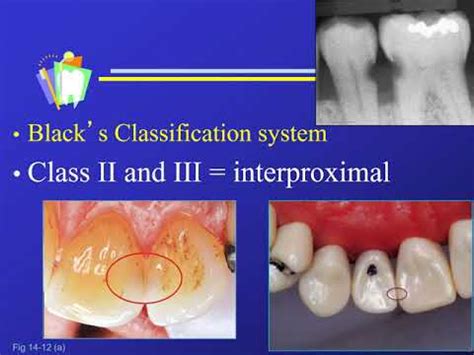 Dr. G.V. Black's Classification of Dental Caries and Restorations - YouTube