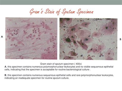 Sputum Culture Gram Stain