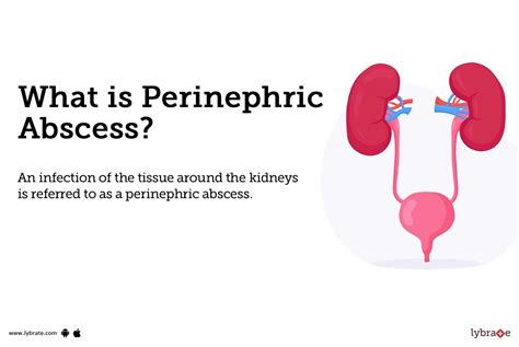 Perinephric Abscess: Causes, Symptoms, Treatment and Cost